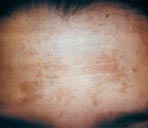 laserowe usuwanie przebarwie�